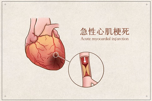 1632675608425937.jpg 摄图网_401789173_急性心肌梗死医疗插画示意图(企业商用).jpg