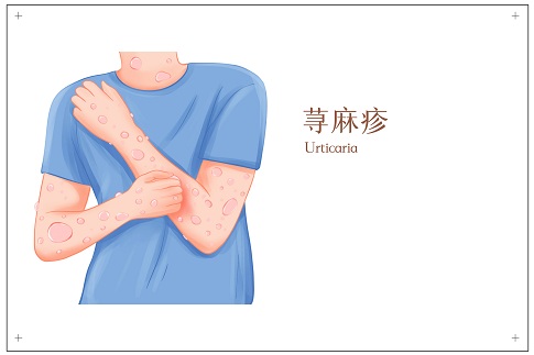摄图网_401804282_皮肤病过敏性荨麻疹医疗插画（企业商用）.jpg