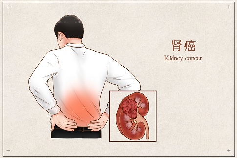 1650989046185352.jpg 摄图网_401793821_banner_肾癌医疗插画(企业商用).jpg