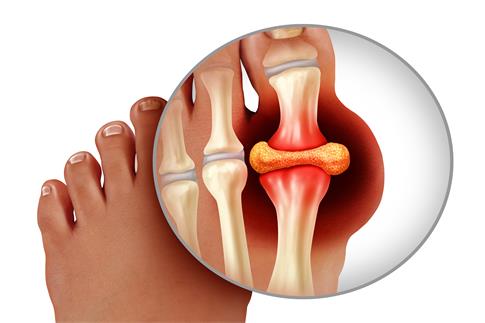 摄图网_307800170_一种手术以3D插图样式作为治疗和诊断白种背景孤立的慢疼痛高血糖贫象征指脚趾紧贴人的作为治疗和诊断白种背景下的慢疼痛标志类风湿（企业商用）.jpg