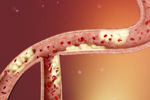 1652888211673599.jpg 摄图网_402138203_banner_三维主动脉粥样硬化场景(企业商用).jpg