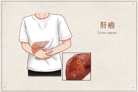 1653321154268908.jpg 摄图网_401794893_banner_肝癌医疗插画(企业商用).jpg