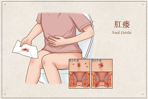 1653580174164635.jpg 摄图网_401799819_banner_肛瘘医疗插画(企业商用).jpg