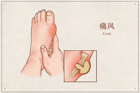 1653843131531128.jpg 摄图网_401794683_banner_痛风医疗插画(企业商用).jpg
