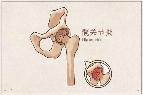 1655656942198987.jpg 摄图网_401789354_髋关节炎示意图(企业商用).jpg