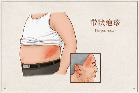 1655737958179292.jpg 摄图网_401800774_banner_带状疱疹医疗插画(企业商用).jpg