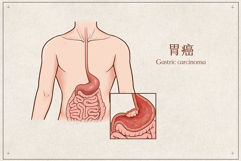 1657043293833817.jpg 摄图网_401789678_胃癌医疗插画(企业商用).jpg