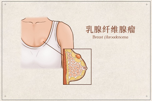1659196941381671.jpg 摄图网_401789492_banner_乳腺纤维腺瘤医疗插画示意图(企业商用).jpg