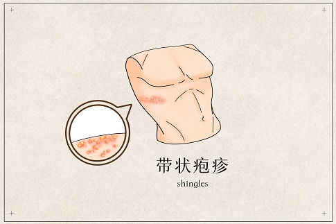 1659282562432061.jpg 摄图网_401789790_带状疱疹医疗插画(企业商用).jpg