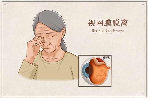 1659375279917275.jpg 摄图网_401866178_banner_视网膜脱离医疗插画(企业商用).jpg