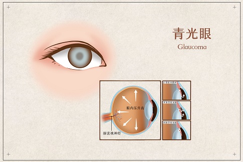 1659973542831971.jpg 摄图网_401804072_青光眼医疗插画(企业商用).jpg