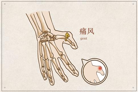 1662050688400722.jpg 摄图网_401795635_banner_手部痛风病例(非企业商用).jpg