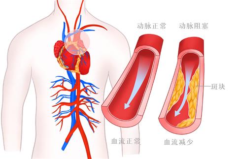 1664381360428575.jpg 摄图网_401802186_banner_高血压血管病变医疗插画(非企业商用).jpg
