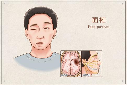 1673626657206736.jpg 摄图网_401863680_banner_面瘫医疗插画(非企业商用).jpg