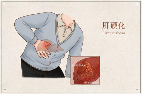 1677859750875928.jpg 摄图网_401795371_banner_肝硬化医疗插画(企业商用).jpg