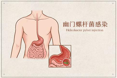 1678821641918760.jpg 摄图网_401789751_banner_幽门螺杆菌感染医疗插画(企业商用).jpg
