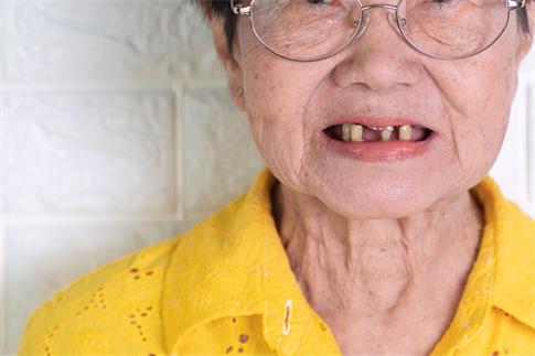 1682394210231459.jpg 摄图网_308021423_70岁以上的亚洲老年妇女笑着微牙齿有几颗断裂的牙齿这里难以咀嚼老人的食物这里需要假牙来替代缺失的齿和帮助咀嚼食物这需要用假牙替换(企业商用).jpg