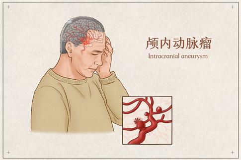 1701071482469643.jpg 摄图网_401796266_颅内动脉瘤医疗插画(企业商用).jpg