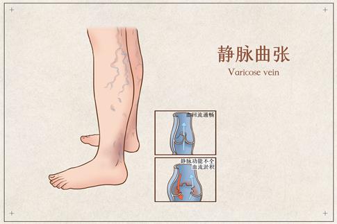 1701387452406509.jpg 摄图网_401799108_静脉曲张医疗插画(企业商用).jpg