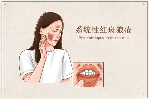 1701735967437085.jpg 摄图网_401794490_系统性红斑狼疮医疗插画(企业商用).jpg