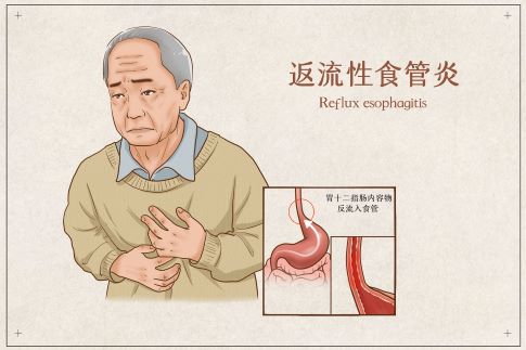 1705739233702908.jpg 摄图网_401804083_反流性食管炎医疗插画(企业商用).jpg