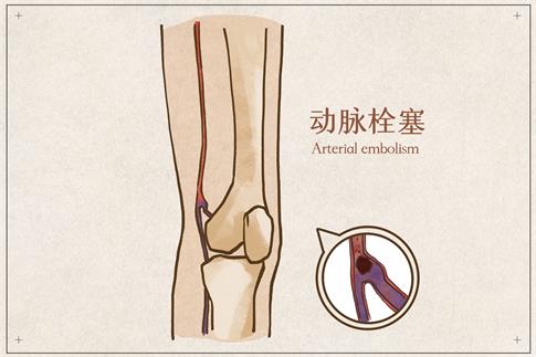 1708917056371122.jpg 摄图网_401790480_动脉栓塞医疗插画(企业商用).jpg