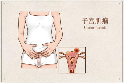 1709511232282588.jpg 摄图网_401800161_子宫肌瘤医疗插画(企业商用).jpg