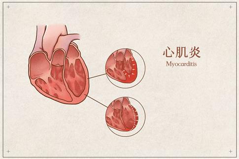 1716259127897064.jpg 摄图网_401789429_心肌炎医疗插画示意图(企业商用).jpg