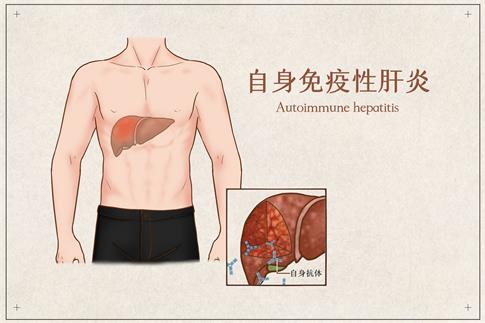 1717201949856627.jpg 摄图网_401794753_自身免疫性肝炎医疗插画(企业商用).jpg